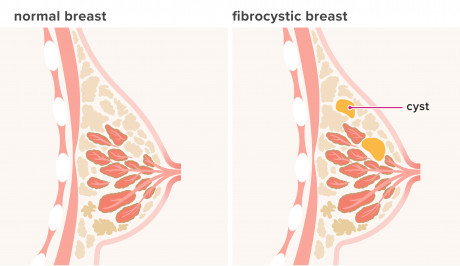 Diseases And Conditions Breast