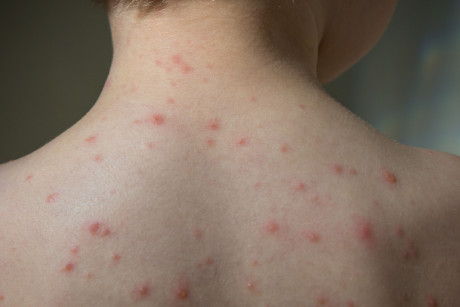 Parents Warned Of Dangerous Chickenpox And Scarlet Fever Cocktail With As Cases